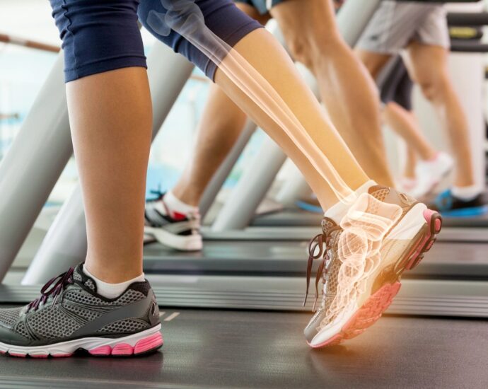walking on treadmill with overlay of bones